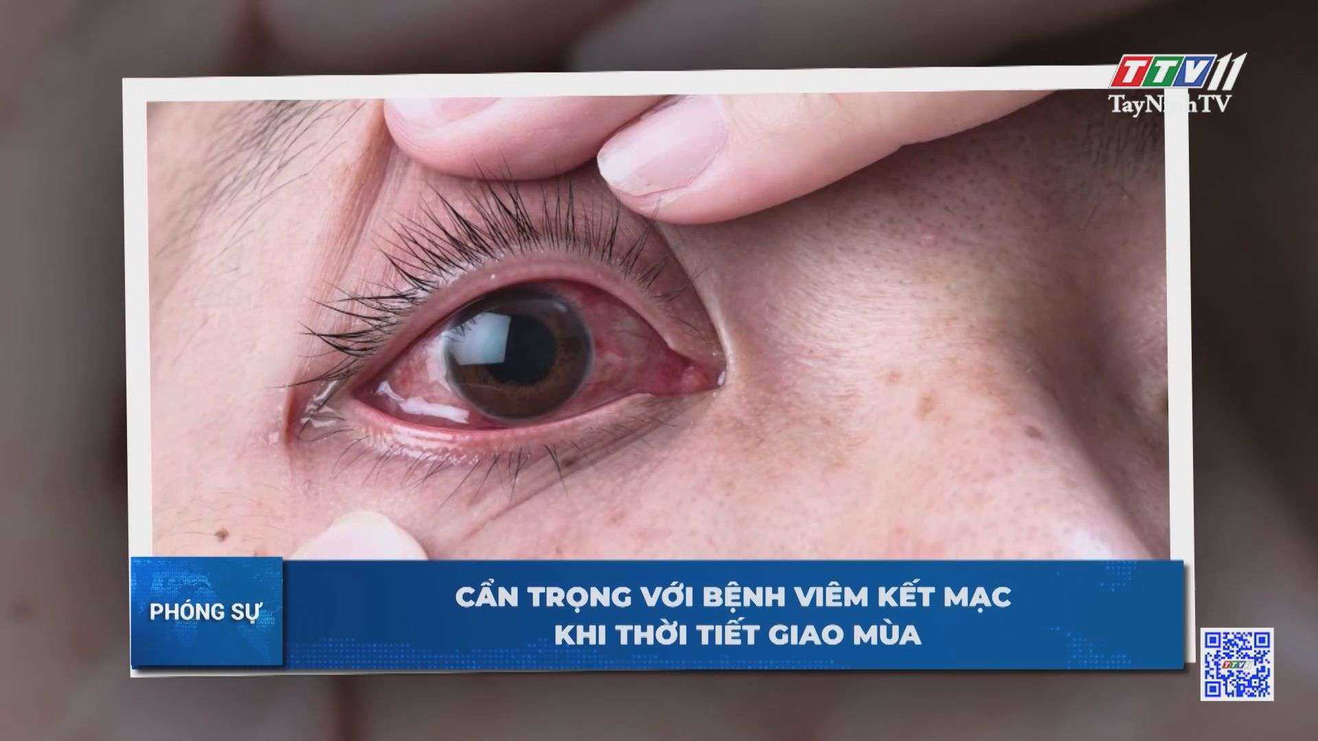 Cẩn trọng với bệnh viêm kết mạc khi thời tiết giao mùa | TayNinhTV